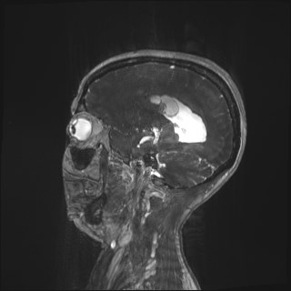 Central neurocytoma (Radiopaedia 84497-99872 Sagittal CISS 8).jpg