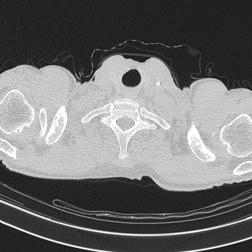 Central venous catheter tip extravasation (Radiopaedia 82828-97113 Axial lung window 6).jpg