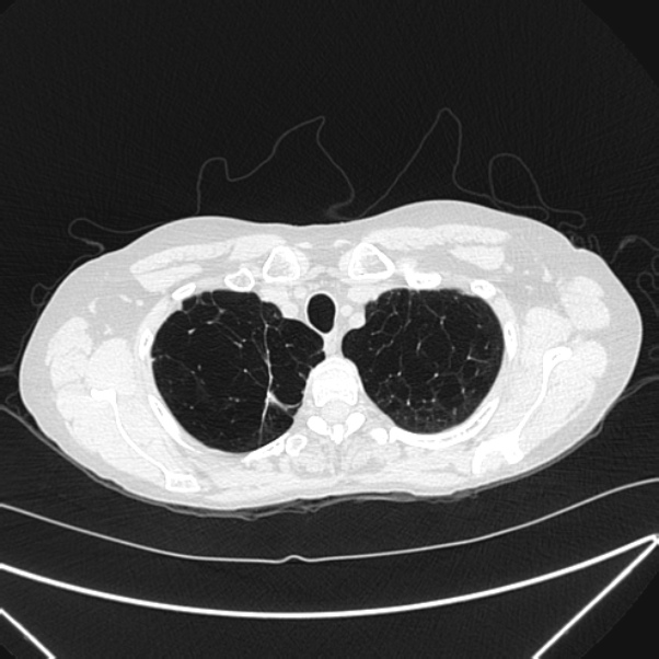 Centrilobular pulmonary emphysema (Radiopaedia 24495-24789 Axial lung window 12).jpg