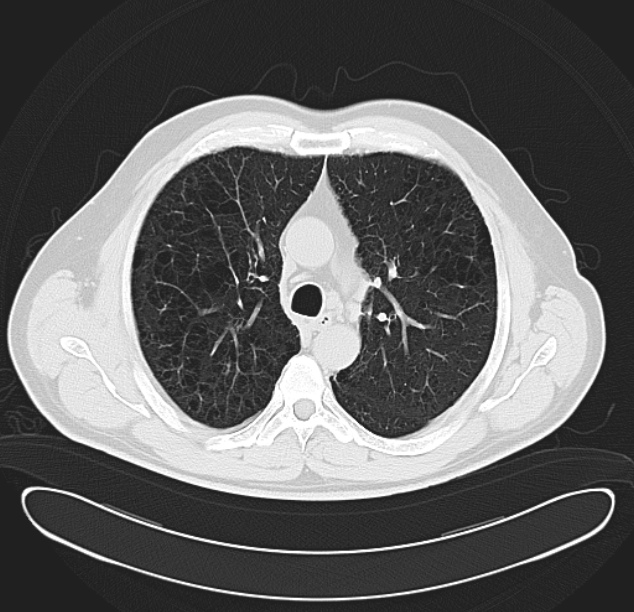 Centrilobular pulmonary emphysema (Radiopaedia 26808-26971 C 16).jpg