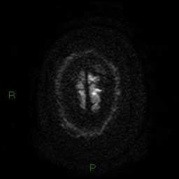Cerebellar abscess (Radiopaedia 78135-90678 Axial DWI 29).jpg