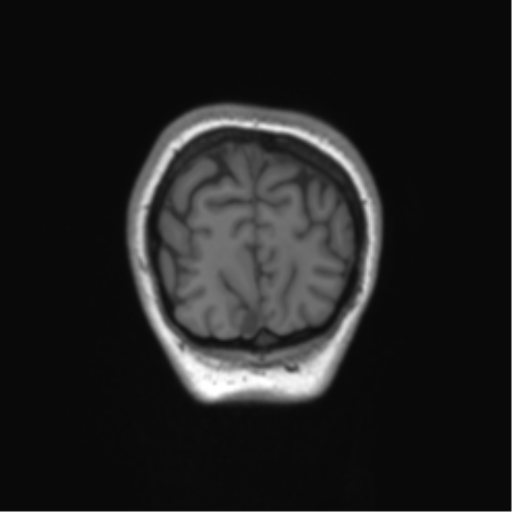Cerebellar agenesis with hypoplastic pons (pontocerebellar hypoplasia) (Radiopaedia 57224-64138 Coronal T1 13).png
