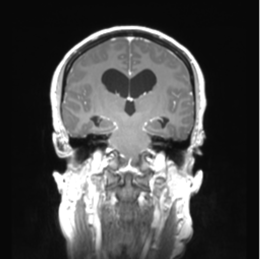 Cerebellar ependymoma complicated by post-operative subdural hematoma (Radiopaedia 83322-97736 Coronal T1 C+ 30).png