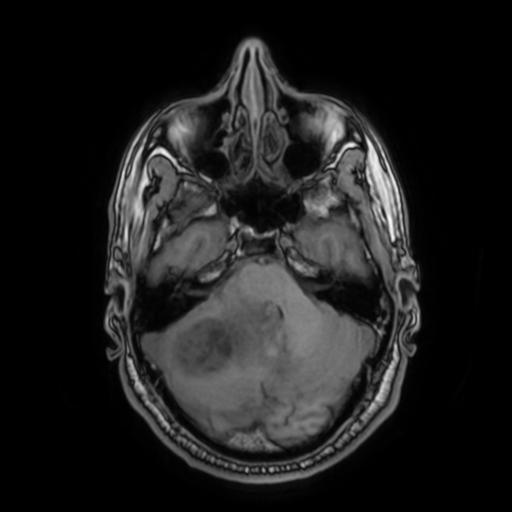 File:Cerebellar hemangioblastoma (Radiopaedia 88055-104622 Axial T1 12).jpg
