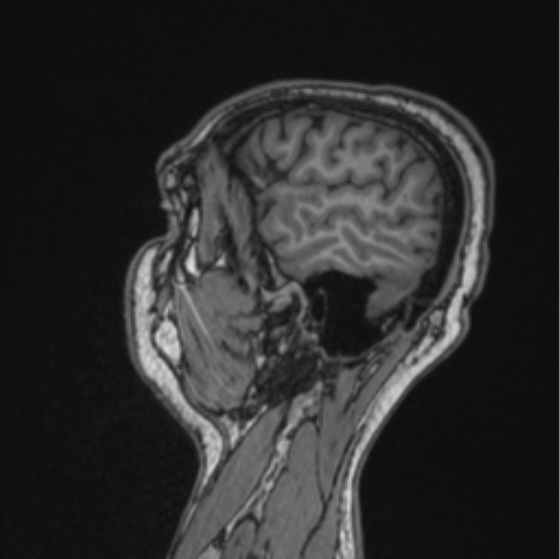 File:Cerebellar hemangioblastomas and pituitary adenoma (Radiopaedia 85490-101176 Sagittal T1 28).png