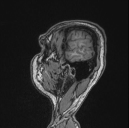 Cerebellar hemangioblastomas and pituitary adenoma (Radiopaedia 85490-101176 Sagittal T1 81).png