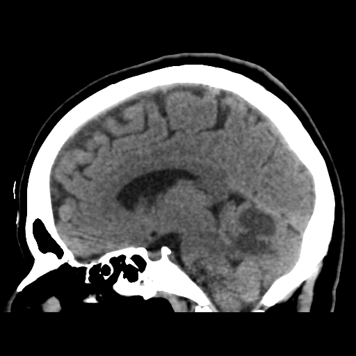 Cerebellar metastasis (cystic appearance) (Radiopaedia 41395-44258 E 31).png