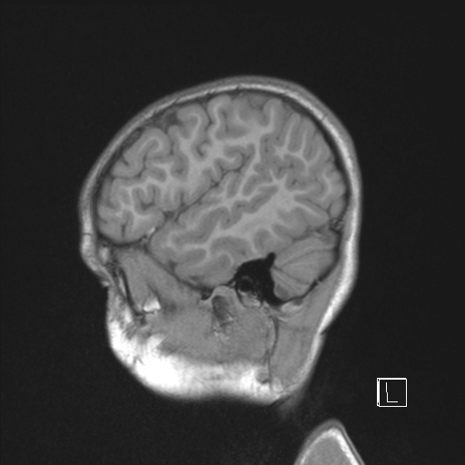 Cerebellar stroke (Radiopaedia 32202-33150 Sagittal T1 C+ 44).png