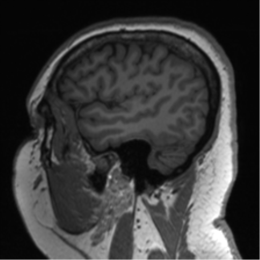 File:Cerebellopontine angle meningioma (Radiopaedia 48434-53348 Sagittal T1 72).png