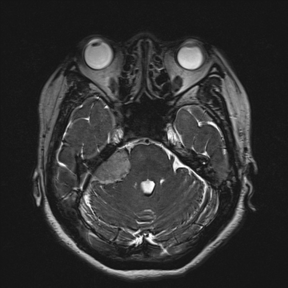 Cerebellopontine angle meningioma (Radiopaedia 53561-59591 Axial 3D volume T2 70).jpg