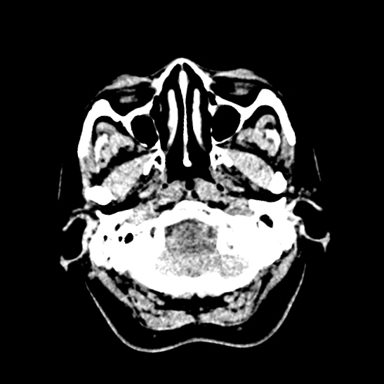 Cerebellopontine angle meningioma (Radiopaedia 53561-59592 Axial non-contrast 8).jpg