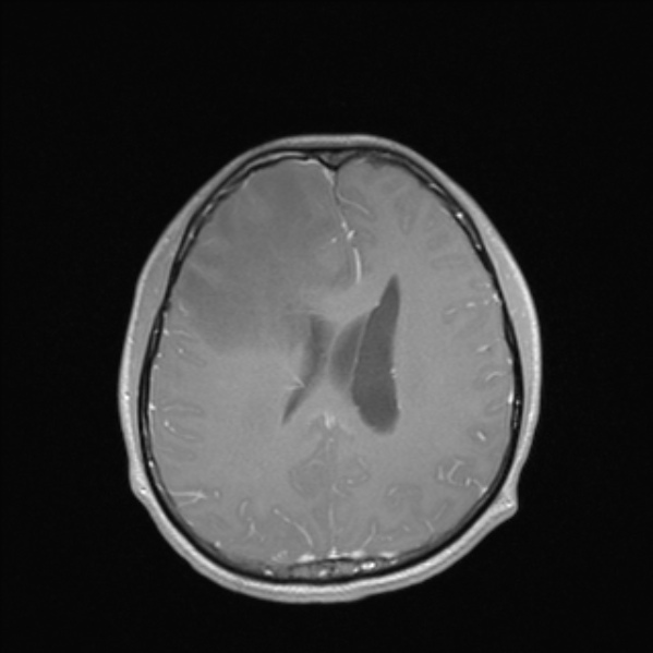 Cerebral abscess (Radiopaedia 24212-24478 Axial T1 C+ 40).jpg