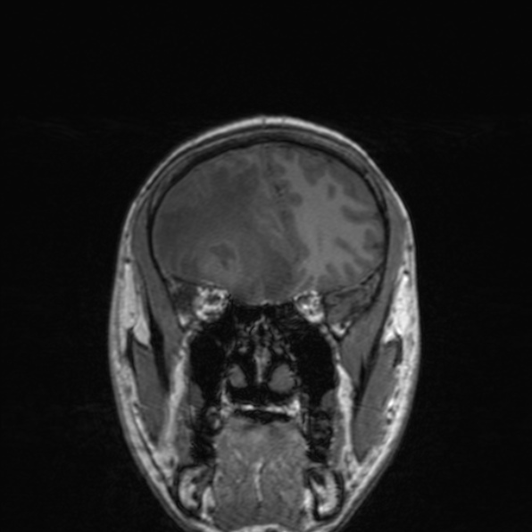 Cerebral abscess (Radiopaedia 24212-24478 Coronal T1 67).jpg