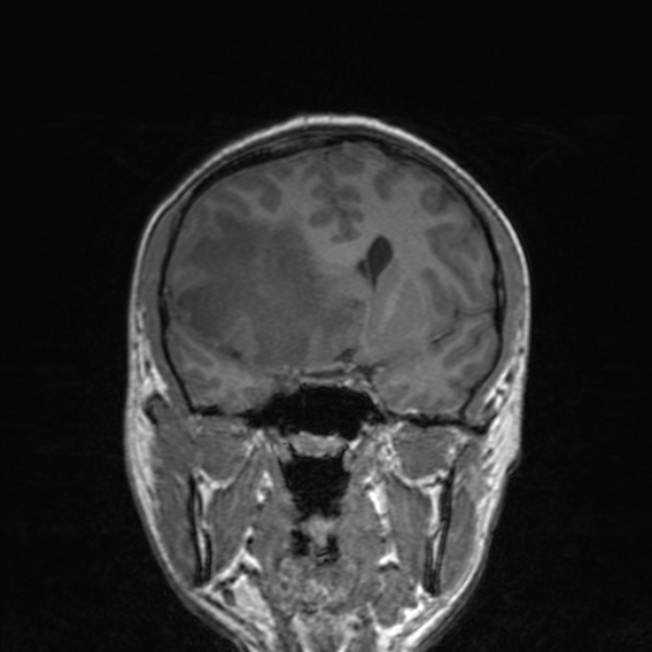 Cerebral abscess (Radiopaedia 24212-24478 Coronal T1 91).jpg