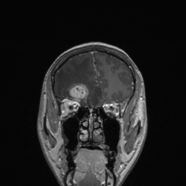 File:Cerebral abscess (Radiopaedia 24212-24478 Coronal T1 C+ 61).jpg