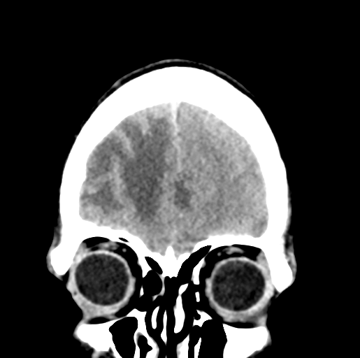 Cerebral abscess (Radiopaedia 60342-68008 Coronal non-contrast 10).png