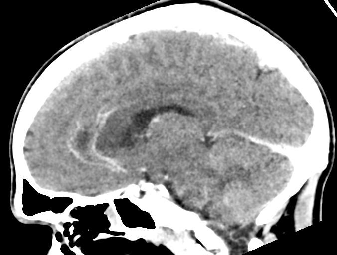 Cerebral abscess (Radiopaedia 60342-68008 Sagittal C+ delayed 23).png