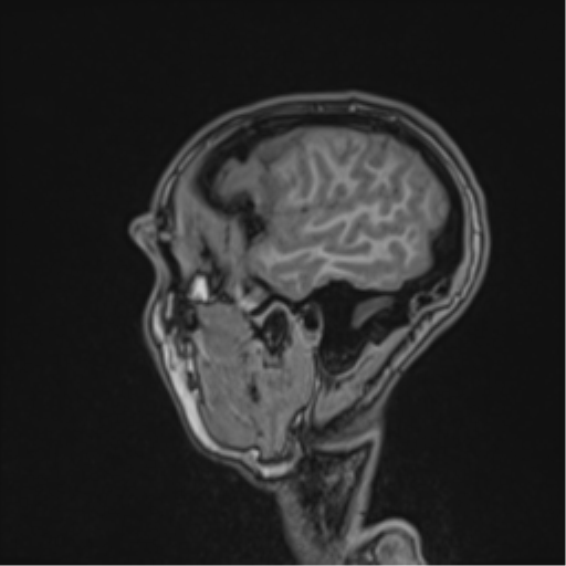 Cerebral abscess (Radiopaedia 60342-68009 Sagittal T1 48).png