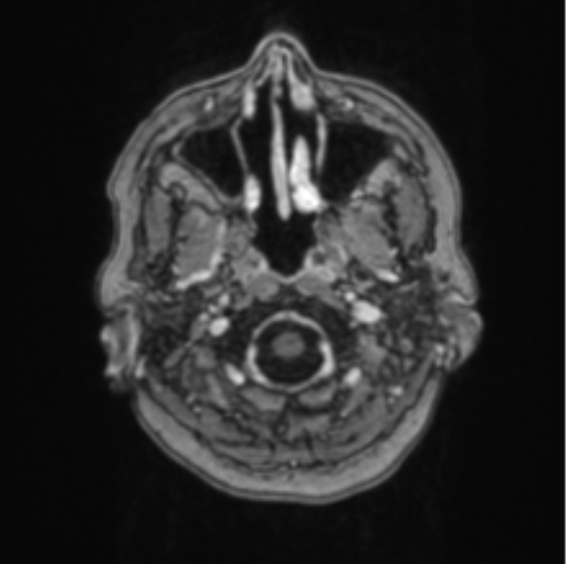 Cerebral abscess from pulmonary arteriovenous malformation (Radiopaedia 86275-102291 Axial T1 C+ 8).png