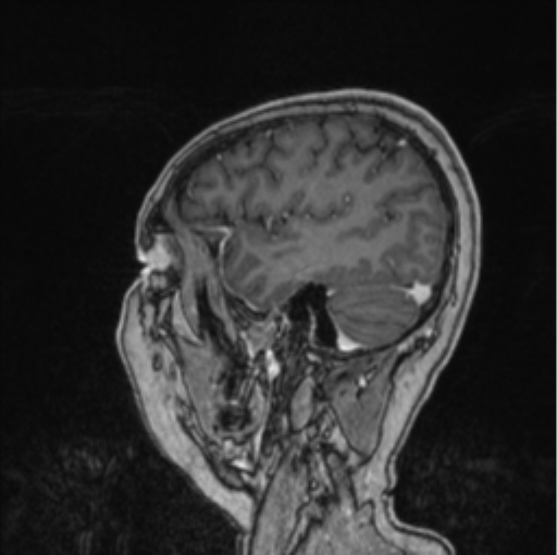 Cerebral abscess from pulmonary arteriovenous malformation (Radiopaedia 86275-102291 Sagittal T1 C+ 18).png