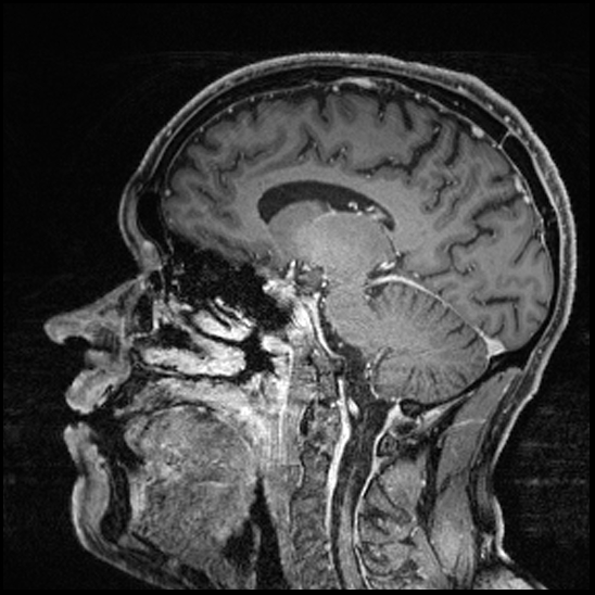 Cerebral abscess with ventriculitis (Radiopaedia 78965-91878 Sagittal T1 C+ 104).jpg