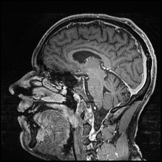 Cerebral abscess with ventriculitis (Radiopaedia 78965-91878 Sagittal T1 C+ 86).jpg
