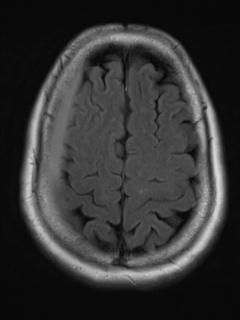 File:Cerebral amyloid angiopathy (Radiopaedia 29129-29518 Axial FLAIR 17).jpg