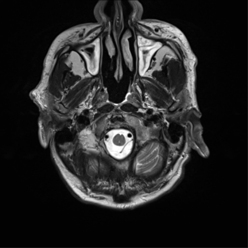 File:Cerebral amyloid angiopathy (Radiopaedia 46082-50433 Axial T2 3).png