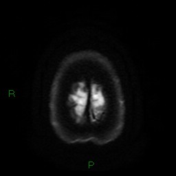 Cerebral amyloid angiopathy (Radiopaedia 77506-89664 Axial DWI 27).jpg
