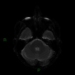 File:Cerebral amyloid angiopathy (Radiopaedia 77506-89664 Axial DWI 37).jpg