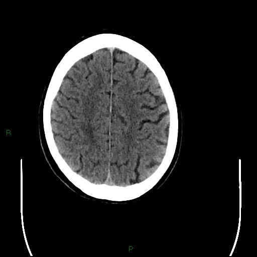 Cerebral amyloid angiopathy (Radiopaedia 77506-89665 Axial non-contrast 83).jpg