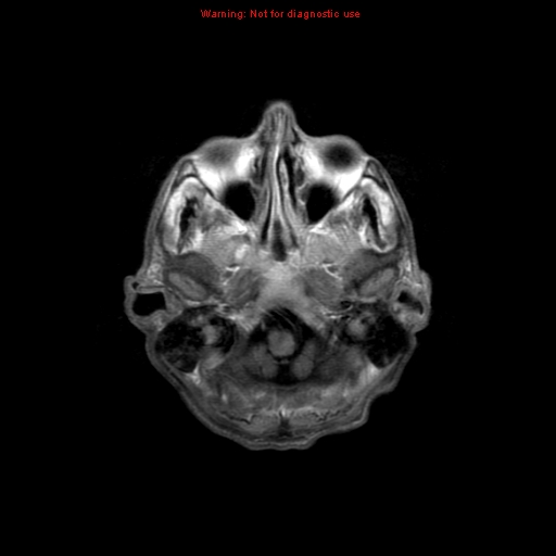 File:Cerebral and orbital tuberculomas (Radiopaedia 13308-13311 Axial T1 C+ 3).jpg