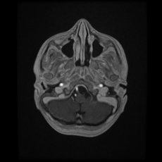 Cerebral and spinal tuberculosis (Radiopaedia 90489-107837 Axial T1 C+ 42).jpg