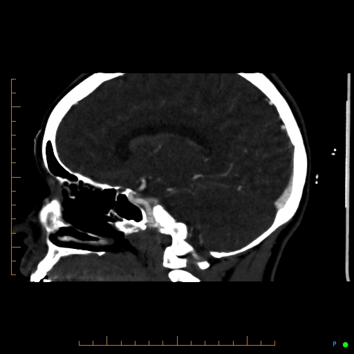 Cerebral arteriovenous malformation (AVM) (Radiopaedia 78162-90706 Sagittal CTA 47).jpg