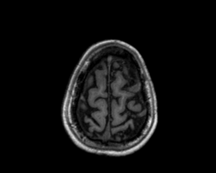 Cerebral arteriovenous malformation (Radiopaedia 30198-30813 Axial T1 16).jpg