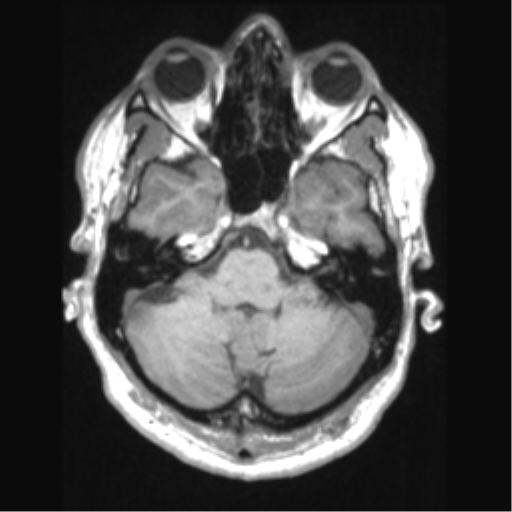 Cerebral arteriovenous malformation (Radiopaedia 39259-41506 Axial T1 19).png