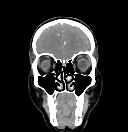 Cerebral arteriovenous malformation (Radiopaedia 73830-84645 C 19).jpg