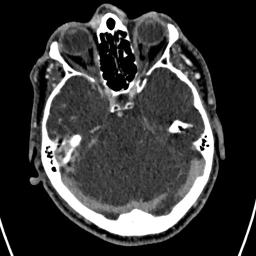 Cerebral arteriovenous malformation (Radiopaedia 78188-90746 Axial C+ delayed 55).jpg