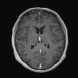 Cerebral arteriovenous malformation (Radiopaedia 84015-99245 Axial T1 C+ 89).jpg