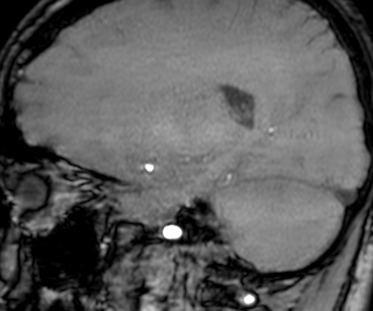Cerebral arteriovenous malformation at posterior body of corpus callosum (Radiopaedia 74111-84925 J 259).jpg