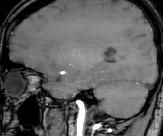 Cerebral arteriovenous malformation at posterior body of corpus callosum (Radiopaedia 74111-84925 J 279).jpg