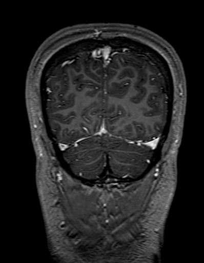 Cerebral arteriovenous malformation at posterior body of corpus callosum (Radiopaedia 74111-84925 K 323).jpg