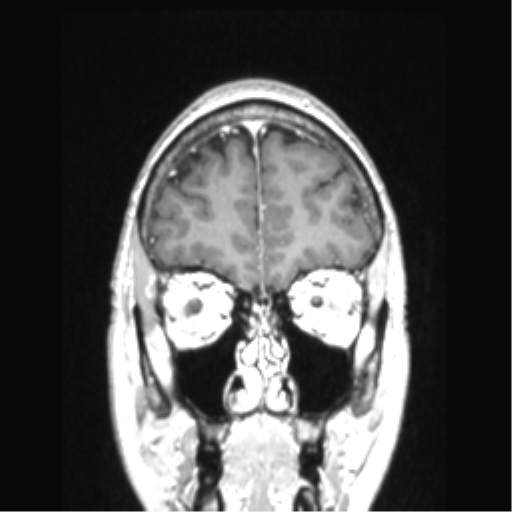 Cerebral arteriovenous malformation with hemorrhage (Radiopaedia 34422-35737 Coronal T1 C+ 76).png