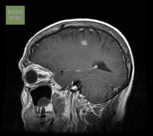 File:Cerebral cavernous malformation (Radiopaedia 11284-11648 Sagittal T1 C+ 1).jpg