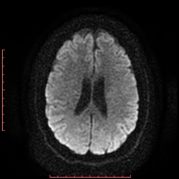 File:Cerebral cavernous malformation (Radiopaedia 26177-26306 Axial DWI 14).jpg