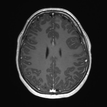 Cerebral cavernous venous malformation (Radiopaedia 70008-80021 Axial T1 C+ 57).jpg