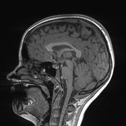 File:Cerebral cavernous venous malformation (Radiopaedia 70008-80021 Sagittal T1 37).jpg