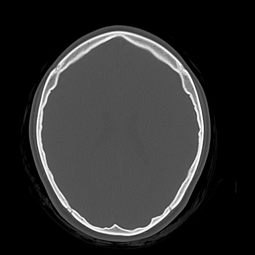 Cerebral cavernous venous malformation (Radiopaedia 70008-80022 Axial bone window 32).jpg