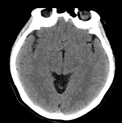 File:Cerebral cavernous venous malformations (Radiopaedia 48117-52945 Axial non-contrast 15).png
