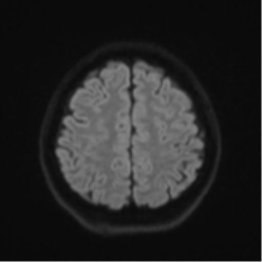 Cerebral cavernous venous malformations (Radiopaedia 48117-52946 Axial DWI 49).png